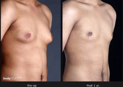 Gynecomastia – Before & After Photos