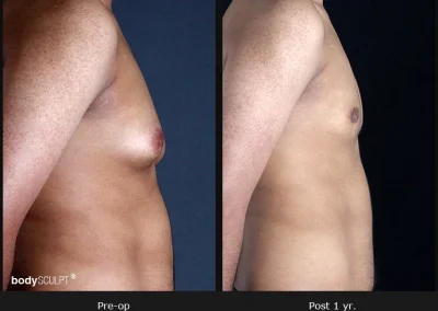 Gynecomastia – Before & After Photos