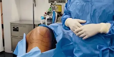 Lateral Thigh Contouring with BodyTite - Patient 1
