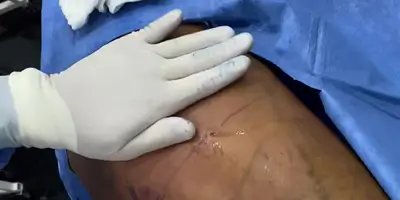 Lateral Thigh Contouring with BodyTite - Patient 2