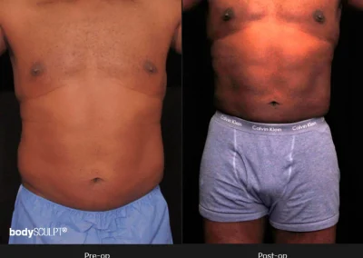 Male Body Contouring -Before/After Photos