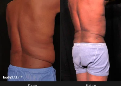 Male Body Contouring -Before/After Photos