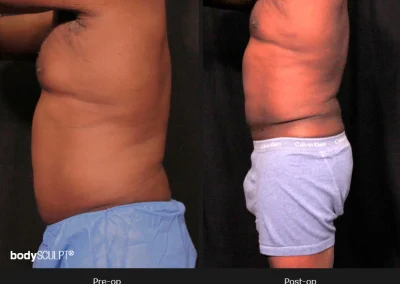 Male Body Contouring -Before/After Photos