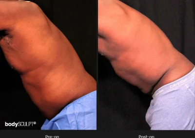 Male Body Contouring -Before/After Photos