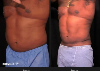 Male Body Contouring -Before/After Photos