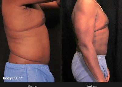 Male Body Contouring -Before/After Photos