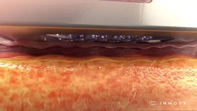 Animation Video of MORPHEUS8 Body With Multi-Pulse Burst Technology