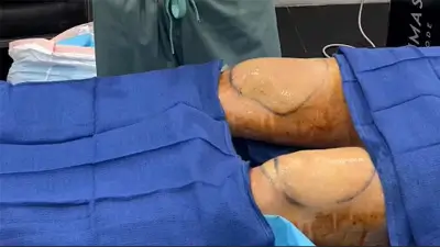 Morpheus8 Body Treatment for Knees and Thighs