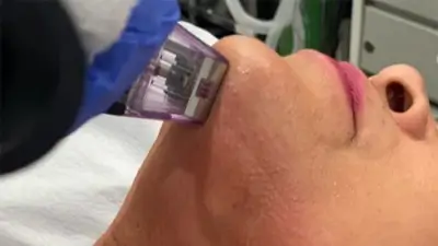 Double Chin Treatment