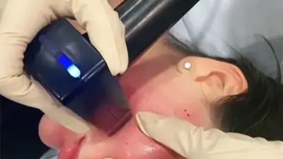 MORPHEUS8 Treatment for Face - Patient 2