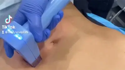 Morpheus8 On The Abdomen