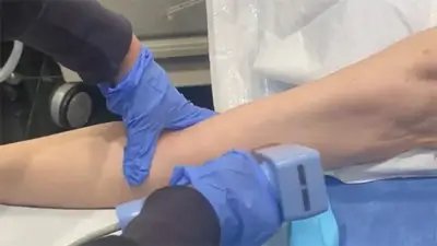 MORPHEUS8 Treatment for Arms