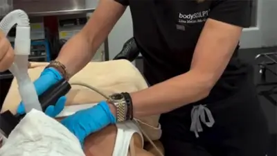 Neck Rejuvenation with Morpheus8 – Patient 4
