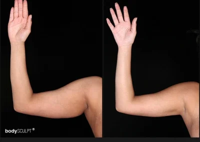 Scarless Female Arm Lift – Before & After Photos