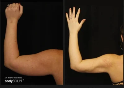 Scarless Female Arm Lift – Before & After Photos