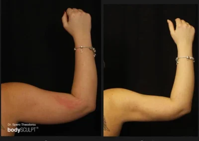 Scarless Female Arm Lift – Before & After Photos