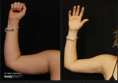 Scarless Female Arm Lift – Before & After Photos