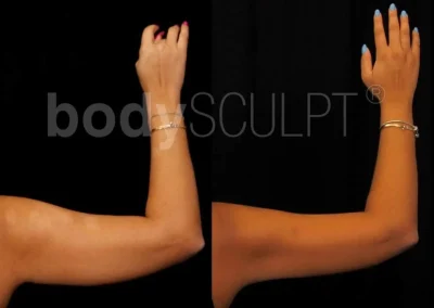 Scarless Female Arm Lift – Before & After Photos