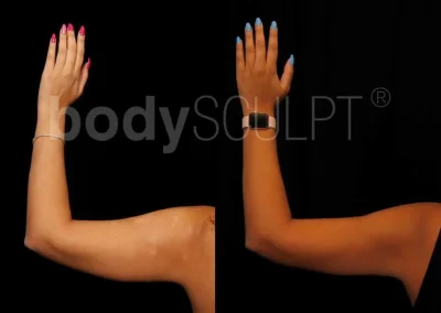 Scarless Female Arm Lift – Before & After Photos