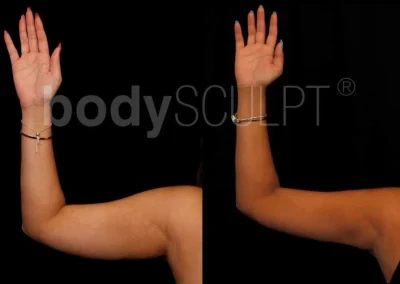 Scarless Female Arm Lift – Before & After Photos
