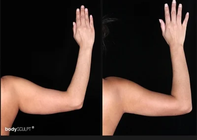 Scarless Female Arm Lift – Before & After Photos