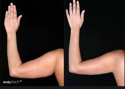Scarless Female Arm Lift – Before & After Photos