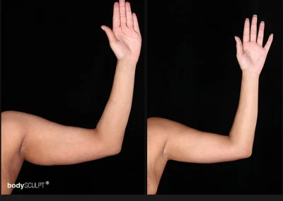 Scarless Female Arm Lift – Before & After Photos