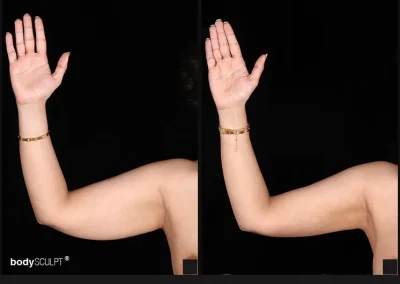 Scarless Female Arm Lift – Before & After Photos