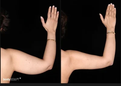 Scarless Female Arm Lift – Before & After Photos