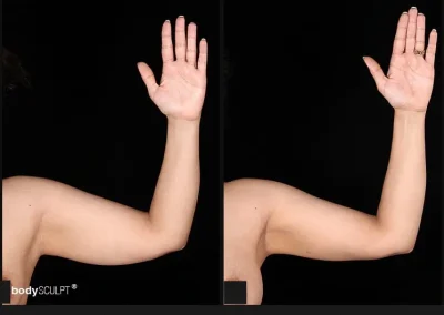 Scarless Female Arm Lift – Before & After Photos