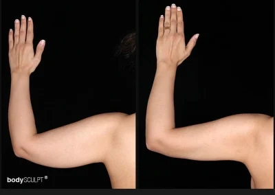 Scarless Female Arm Lift – Before & After Photos