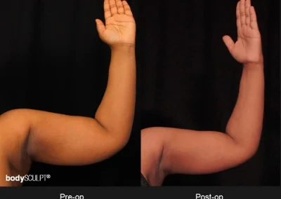 Scarless Female Arm Lift – Before & After Photos