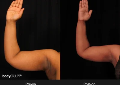 Scarless Female Arm Lift – Before & After Photos