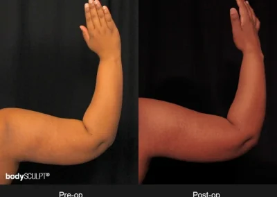 Scarless Female Arm Lift – Before & After Photos