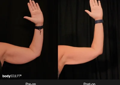 Scarless Female Arm Lift – Before & After Photos