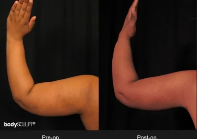 Scarless Female Arm Lift – Before & After Photos