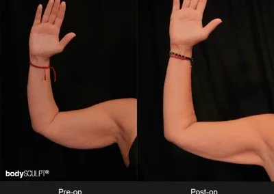 Scarless Female Arm Lift – Before & After Photos