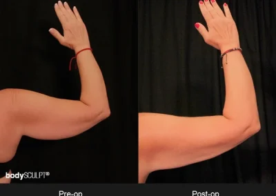 Scarless Female Arm Lift – Before & After Photos