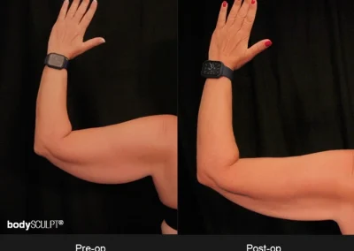 Scarless Female Arm Lift – Before & After Photos