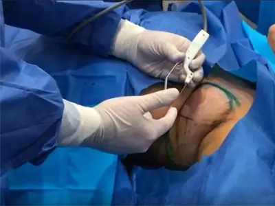 AccuTite Axillary Fat Removal