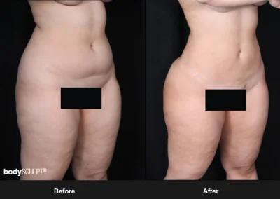 Brazilian Butt Lift under Local Anesthesia – Before & After Photos