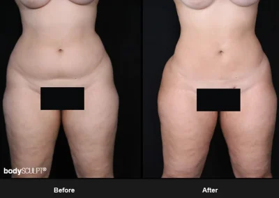 Brazilian Butt Lift under Local Anesthesia – Before & After Photos