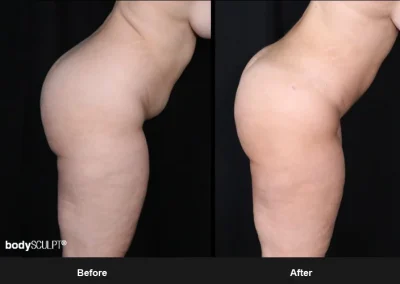 Brazilian Butt Lift under Local Anesthesia – Before & After Photos