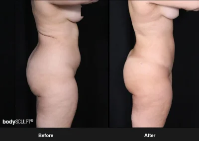 Brazilian Butt Lift under Local Anesthesia – Before & After Photos