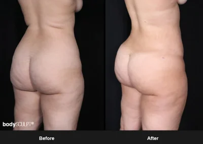Brazilian Butt Lift under Local Anesthesia – Before & After Photos