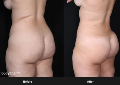 Brazilian Butt Lift under Local Anesthesia – Before & After Photos