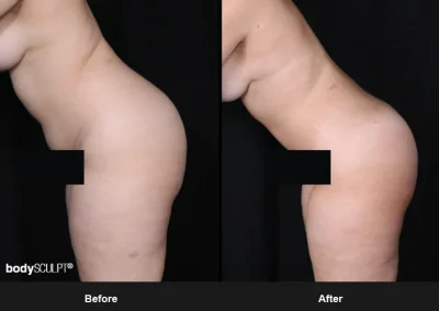 Brazilian Butt Lift under Local Anesthesia – Before & After Photos