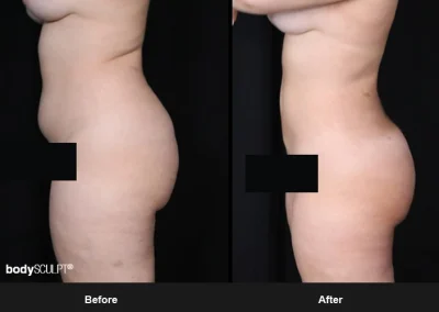 Brazilian Butt Lift under Local Anesthesia – Before & After Photos