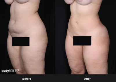 Brazilian Butt Lift under Local Anesthesia – Before & After Photos