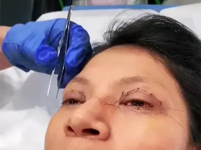 Blepharoplasty